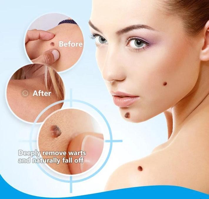 Warts Solution™ – Wratten en huids tag verwijderaar behandeling cream